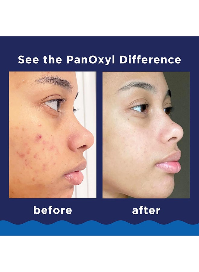PanOxyl Acne Foaming Wash, Peroxide 10% Maximum Strength 5.5 Oz Packaging May Vary....
