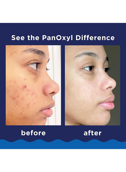 PanOxyl Acne Foaming Wash, Peroxide 10% Maximum Strength 5.5 Oz Packaging May Vary....